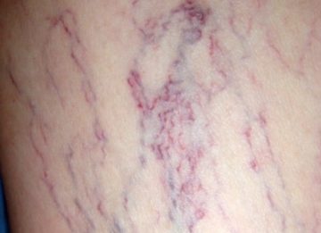 Симптомы и лечение закупорки вен на ногах в домашних условиях