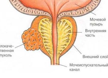 Злокачественная опухоль простаты