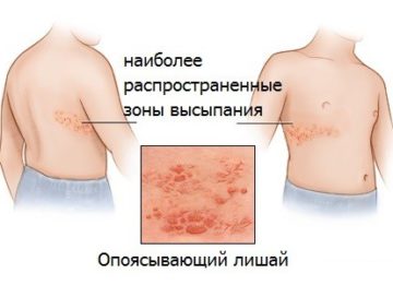 Заразен ли опоясывающий лишай или нет?