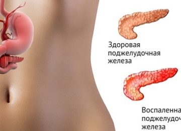 Причины и симптомы воспаления поджелудочной железы