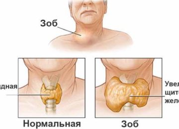 Народные средства против причин и симптомов зоба щитовидной железы
